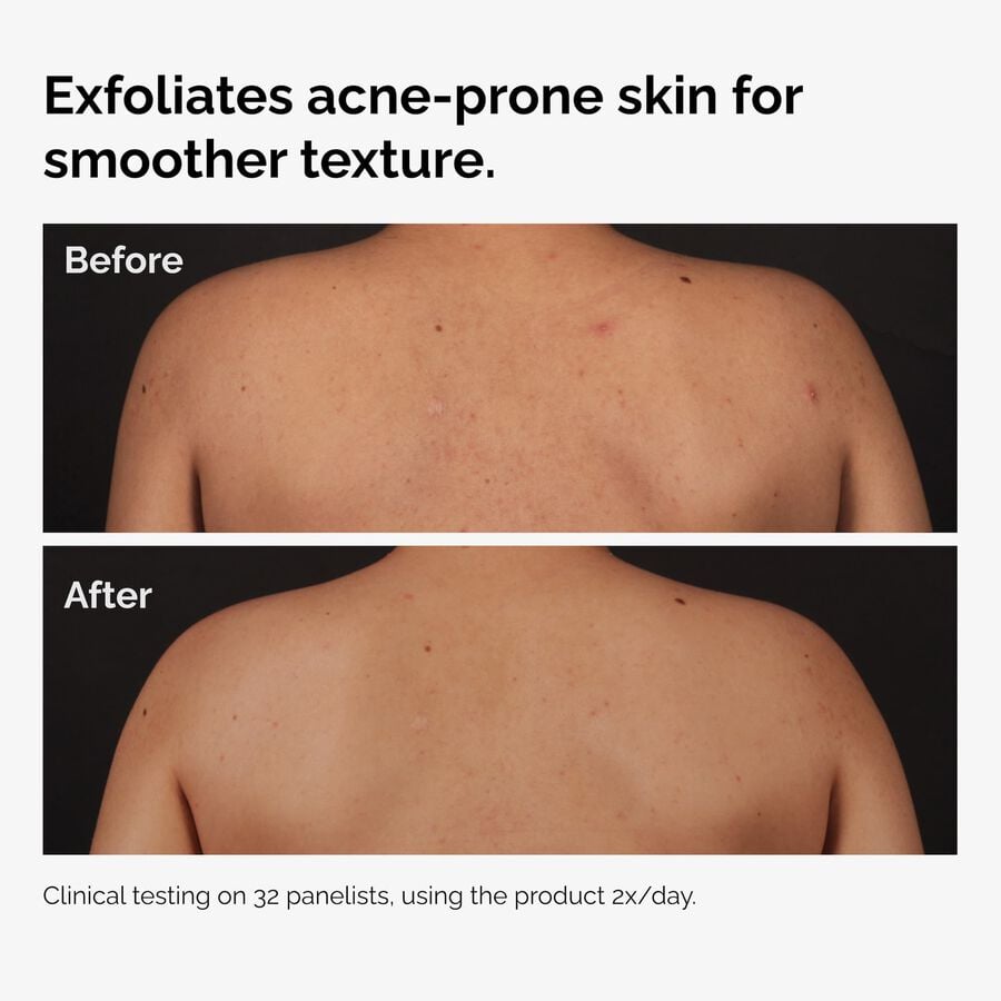 the-body-care-collection-w2 ord-salicylic-acid-body-serum-before-after-graphic-NA.jpg