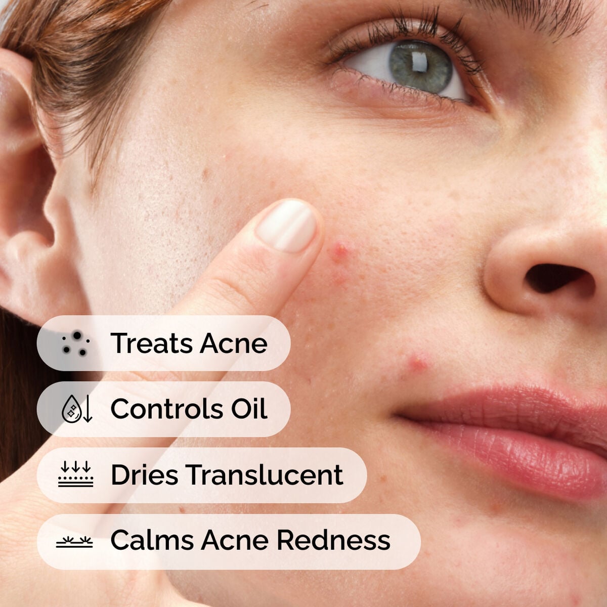 sulfur-10-powder-to-cream-concentrate-m1 ord-sulfur-10pct-powder-to-cream-concentrate-model-application-with-benefits-acne.jpg