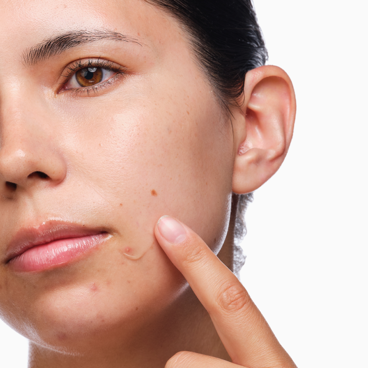 the-acne-set-h8 rdn-the-acne-set-application.png